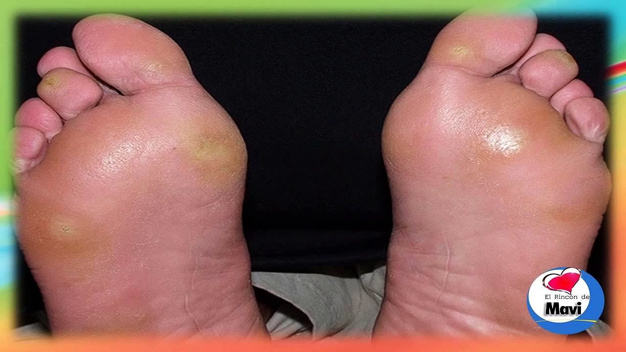Remedios caseros para callos o callosidades y durezas en los pies