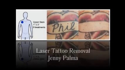 Tattoo Removal Services By Jenny Palma