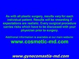 Dr Blau - Gynecomastia Surgery cost- Severe - Male Breast Reduction  - Male Breast Treatment Cost