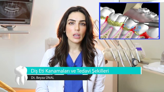 Dt. Beyza ÜNAL - Diş Eti Kanamaları ve Tedavi Şekilleri