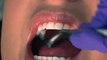 جلسات الفلورايد لتقويه الأسنان و حمايتها من التسوس Fluoride Varnish Application