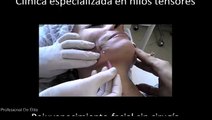 Clínica hilos tensores de sostén Distrito Federal 999-888-777 Rejuvenecimiento facial con hilos