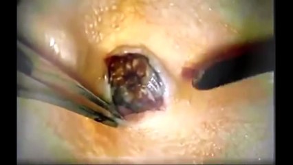 Download Video: Blackheads, Whiteheads and Enormous Cysts;  Which is your Favorite?