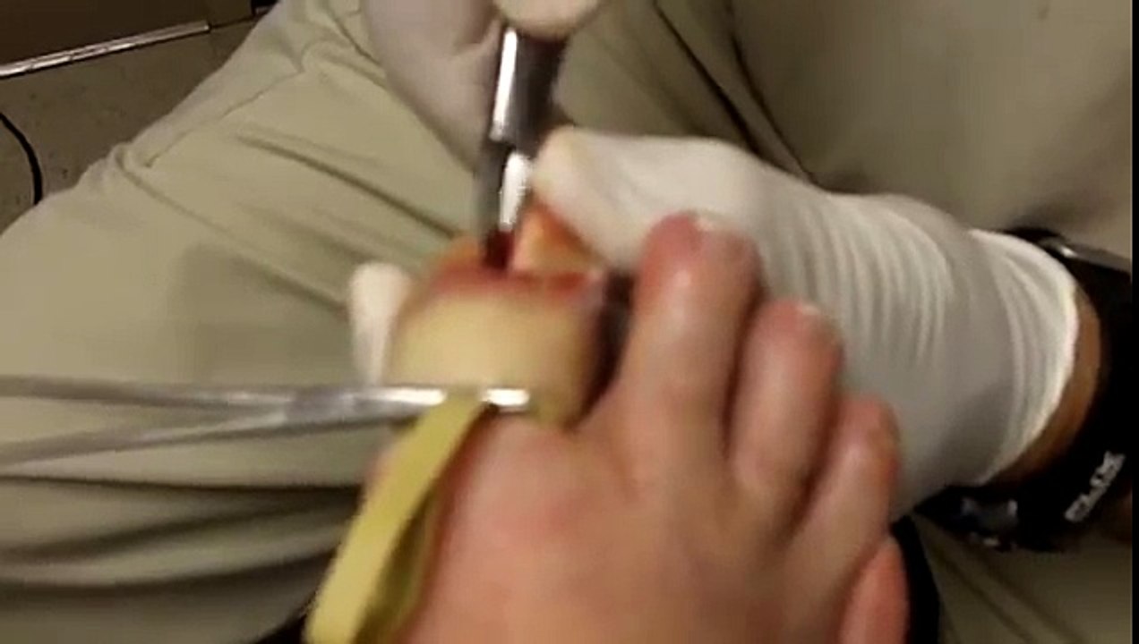 Permanent Ingrown Toenail Removal