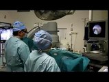 Pulvérisation au laser d'un calcul dans l'uretère par le Docteur Jack-Charles Tremeaux
