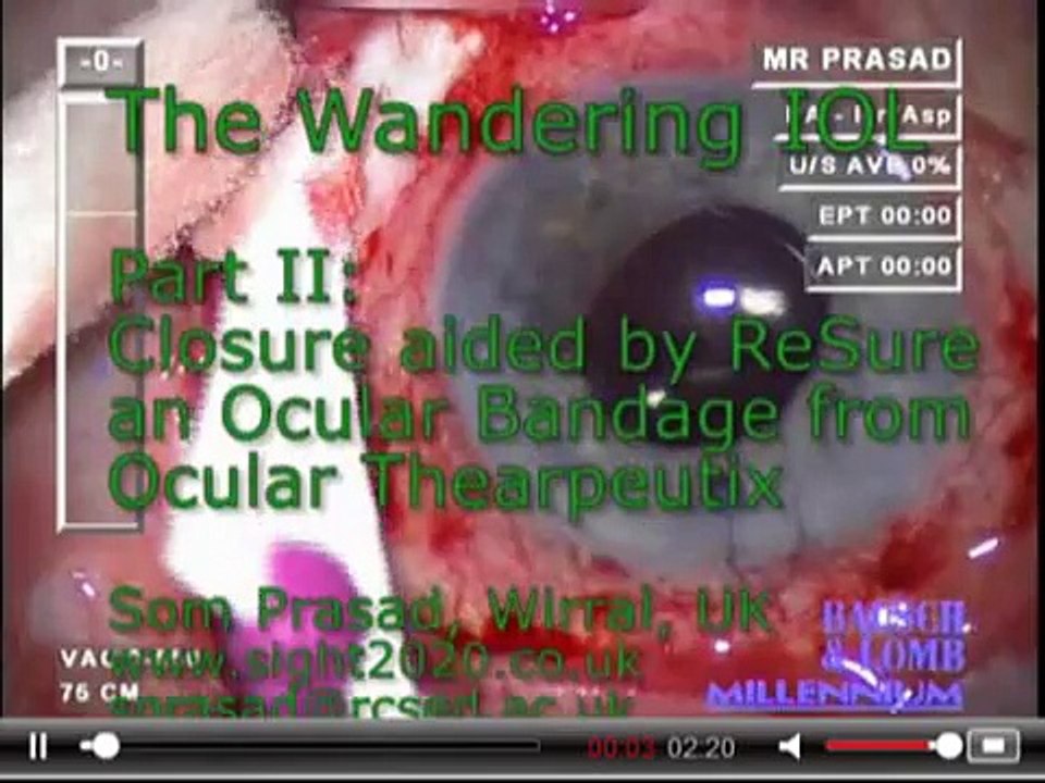 The Wandering IOL Part II by Dr Som Prasad