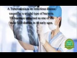 Tuberculosis history symptoms and treatment