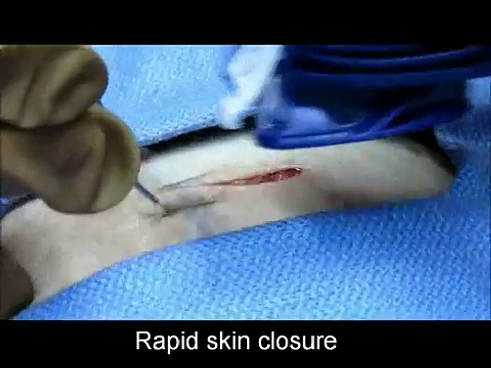 Agrafes Résorbables intradermiques INSORB DERMATOLOGIE.mp4