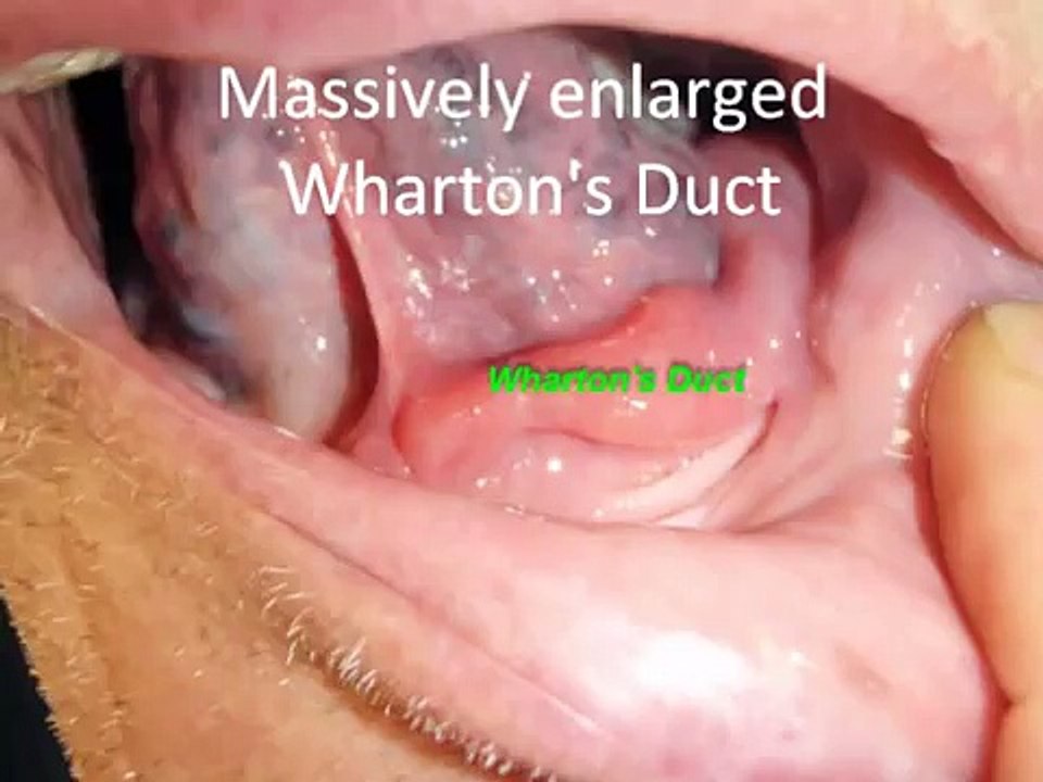 Really BIG Salivary Gland Stones