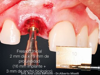 REGENERACION ÓSEA GUIADA EN IMPLANTES DENTALES