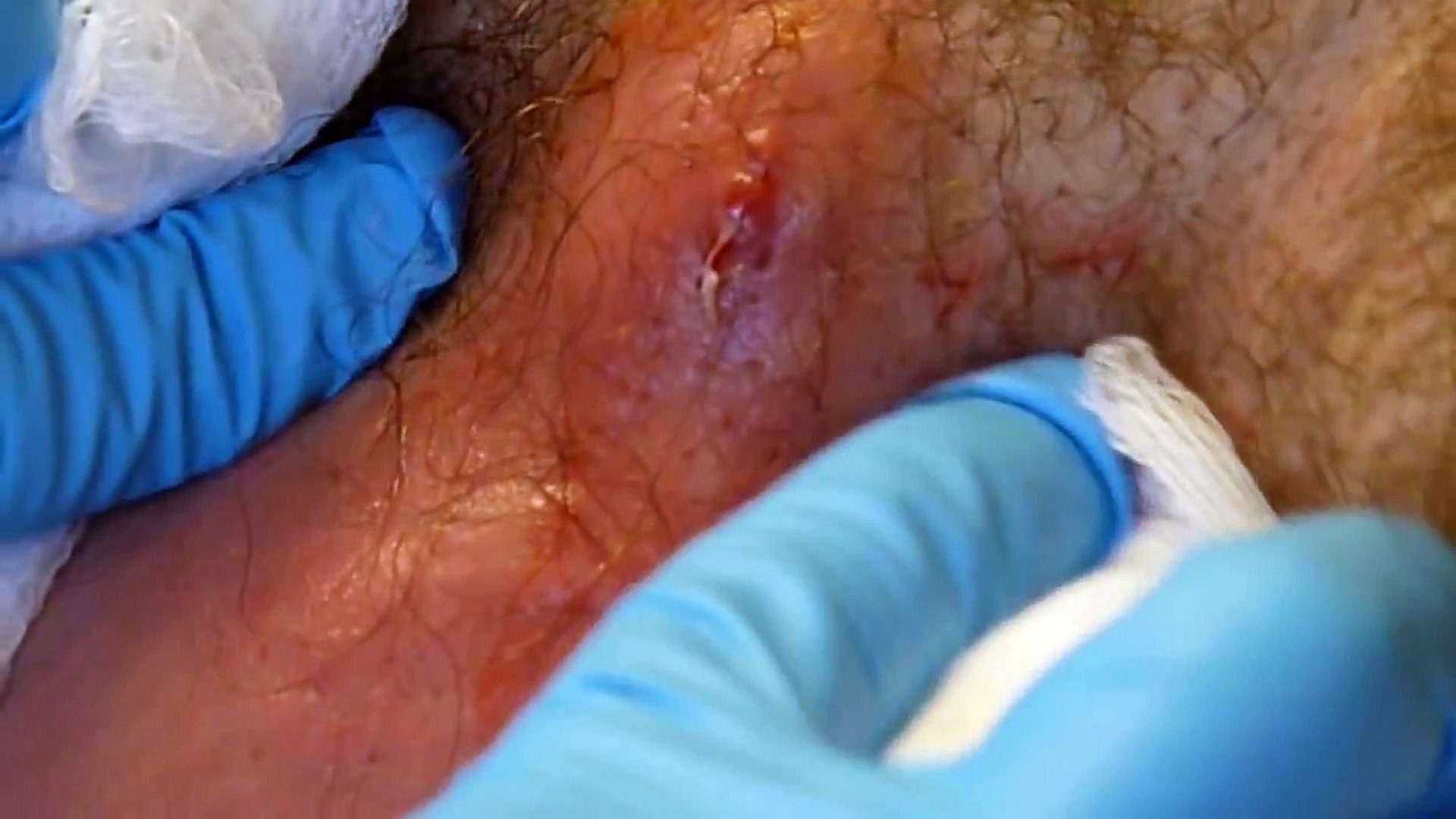 Huge Abscess Staph Infection Popped In Armpit Huge Plug Removed