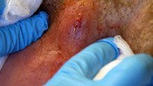 HUGE ABSCESS/STAPH INFECTION POPPED IN ARMPIT ..HUGE PLUG REMOVED...BEST ABSCESS  DRAINAGE EVER!!!!