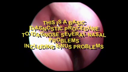 NASAL ENDOSCOPY