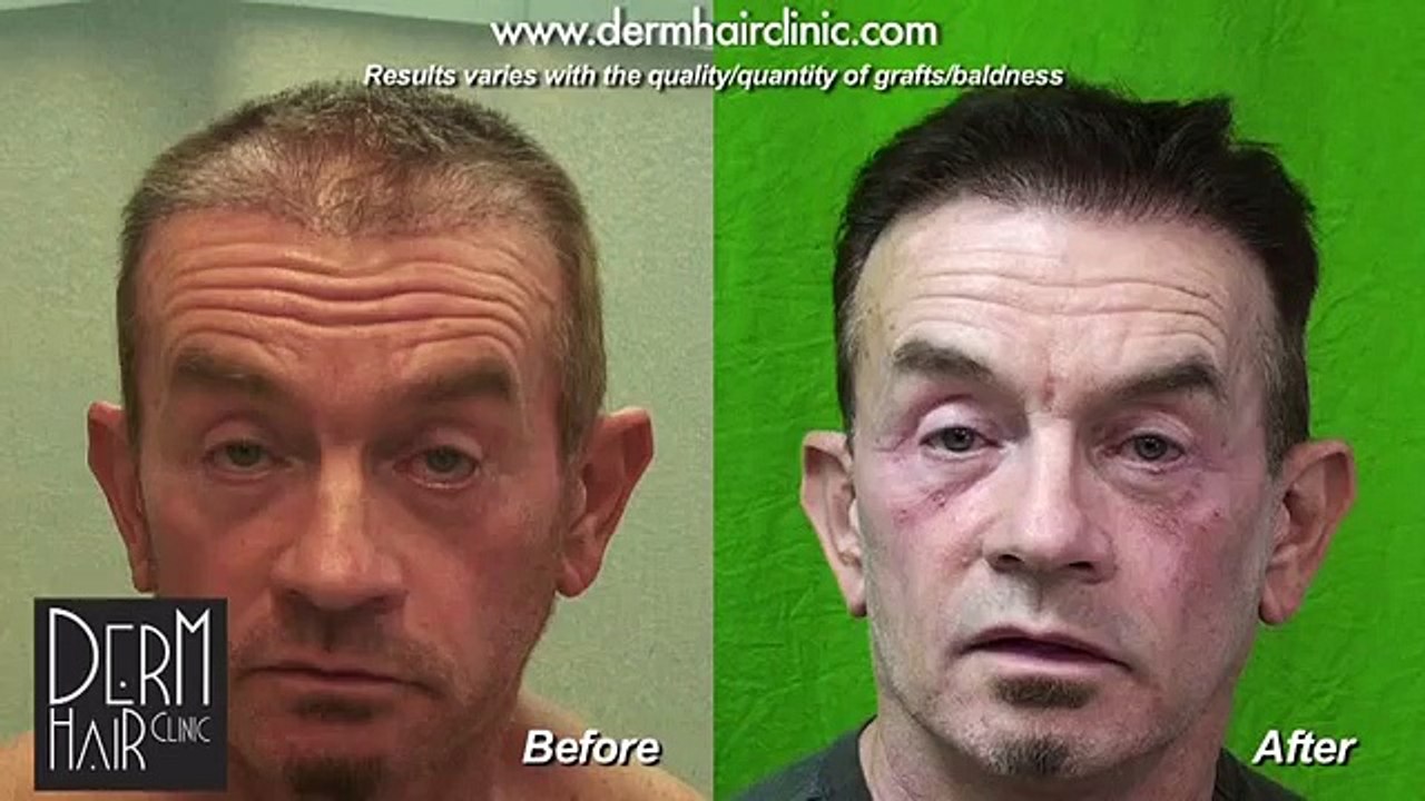 Bad FUE hair transplant result repaired - before and after