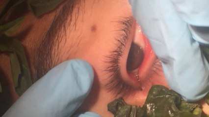 One Inch WORM Removed from Underneath Boy’s Eye