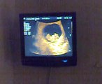 Echo 10 weken zwanger