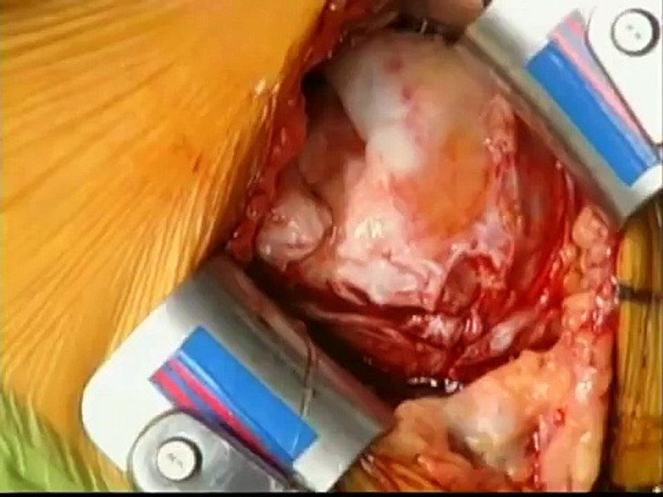 Shoulder Surgery: Full Thickness Rotator Cuff Tear Repair