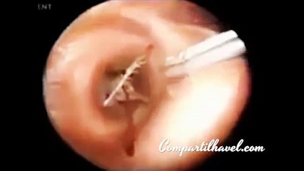 ★ VEJA O QUE O MÉDICO RETIROU DE DENTRO DO OUVIDO Desse Homem. Eu Não Acreditei Quando Vi