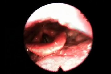 Throat Endoscopy Exam - While Singing