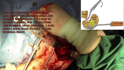 Open Reduction of Chronic Posterior Shoulder Dislocation