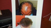 Bald Vertex/Crown Hair Restoration Surgery Result 1 Year  Before And After Diep www.mhtaclinic.com