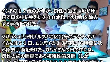 【閲覧注意】インドの少年から232本の歯を摘出