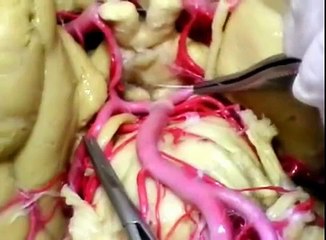 NEUROANATOMÍA 2.0: IRRIGACIÓN DEL SNC 1/3; CIRCULO ARTERIAL CEREBRAL-POLIGONO DE WILLIS