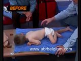 ABR terapija za cerebralna paraliza - P.J.