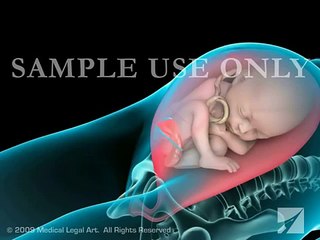 Cesarean Section (C-Section)