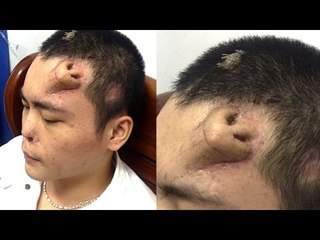 Man Grows Nose On Forehead