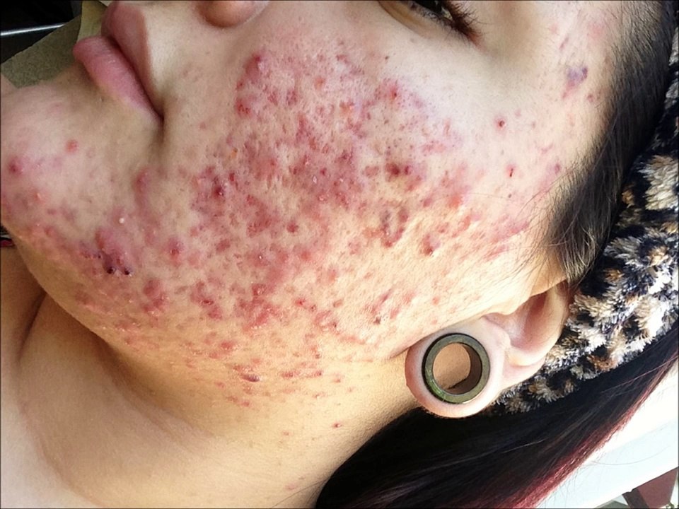 Before & After Accutane SEVERE Acne Progress Video [Shitty Quality]