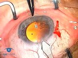 Conjunctival Ballooning Phaco 3.1 Complications