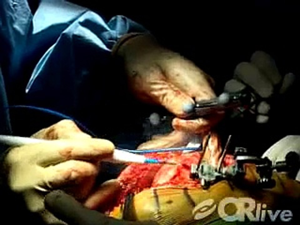 Computer-Assisted Total Knee Replacement