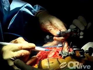 Computer-Assisted Total Knee Replacement