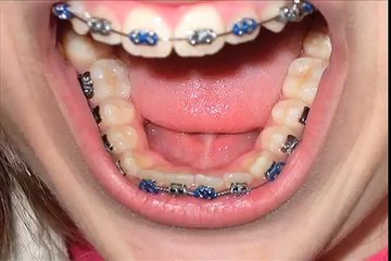 Braces timelapse!