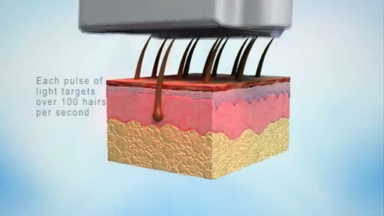 Phaser EPL - Hair Removal ( IPL Laser )