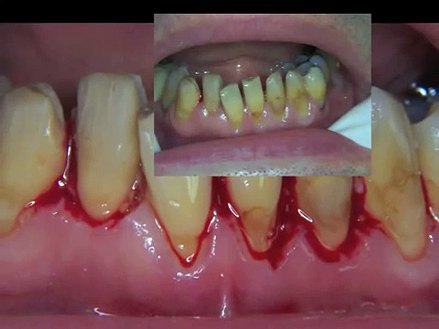 Facettes dentaires sur les dents du bas: mode d'emploi. - video Dailymotion
