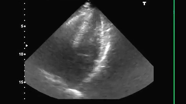Fibrillation Auriculaire (FA) en échographie - Atrial Fibrillation (AF) ultrasound