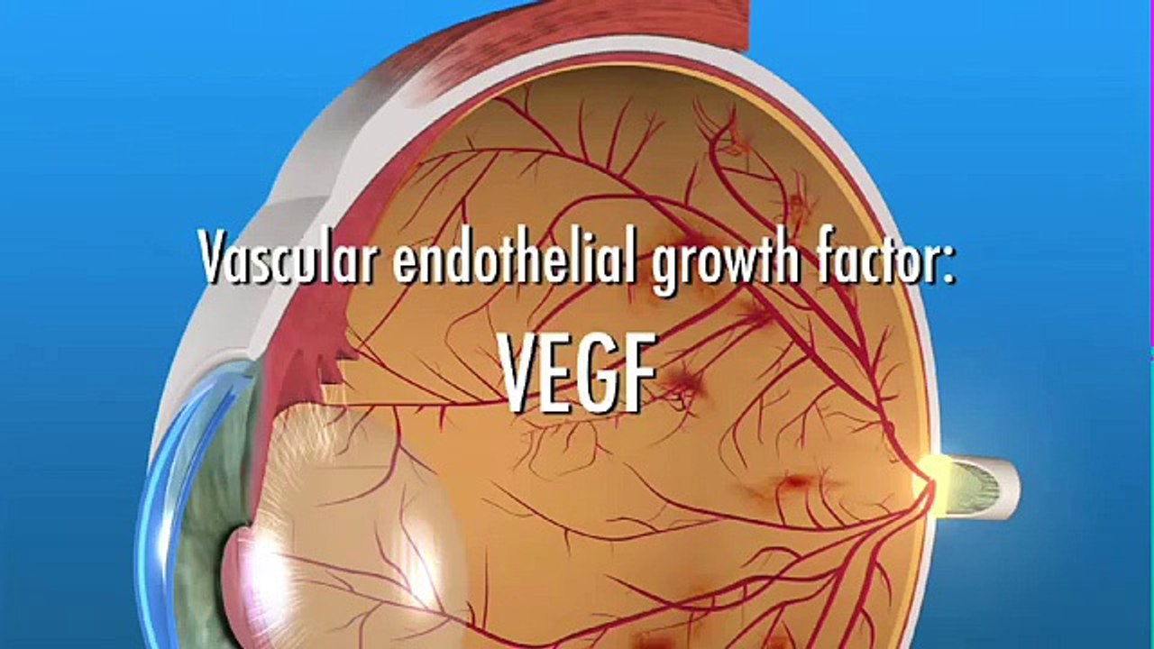 Anti VEGF Treatment for PDR