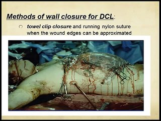 Damage control Laparotomy