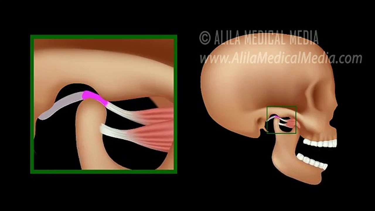 Temporomandibular Joint (TMJ) Anatomy and Disc Displacement Animation ...