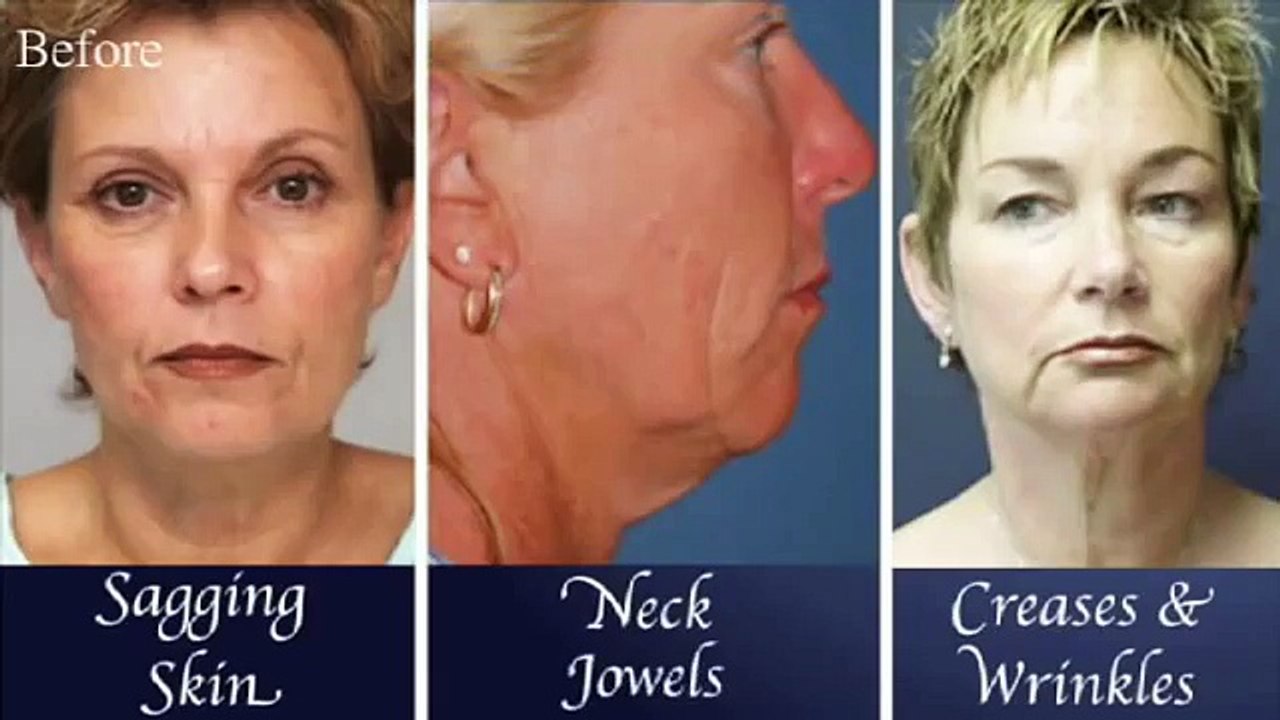 Liftingul facial iti confera o intinerire si netezire a tenului !