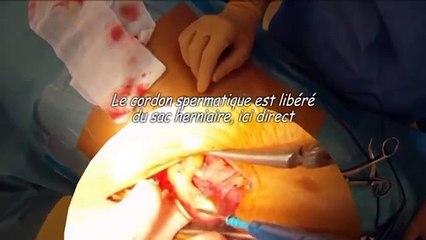 Hernie inguinale droite directe (Direct inguinal hernia repair)