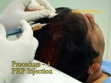 PRP HAIRLOSS TREATMENT - Video Dailymotion