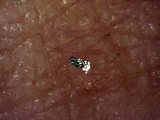 Morgellons glitter and black specks