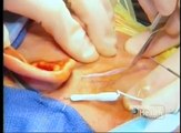 Mark Stein, D.D.S., M.D. performs Jaw Surgery to reconstruct the jaw of two patients.