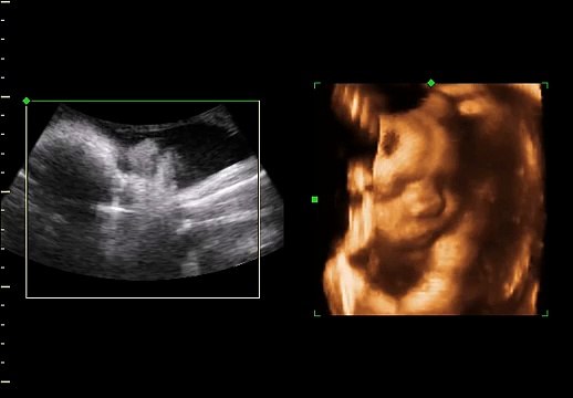3D and 4D ultrasounds pictures Sandy,UT