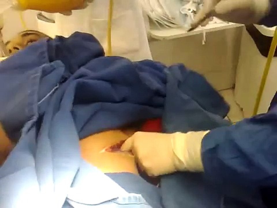 Trauma con RCP