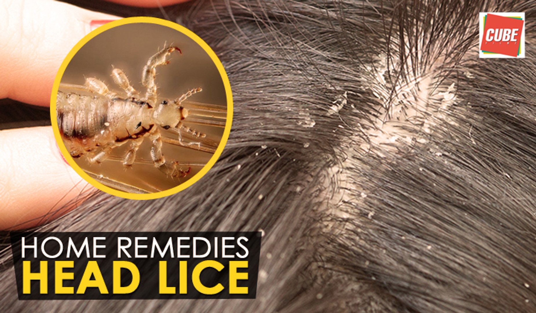 Head lice - Home Remedies | Health Tips - video Dailymotion
