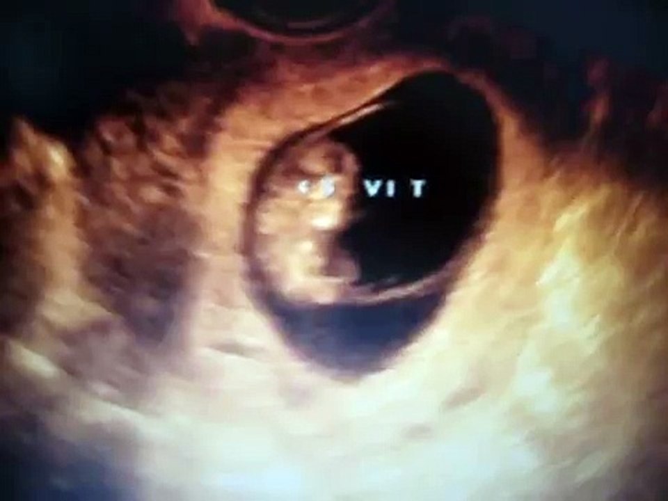 Ecografia 10 semanas